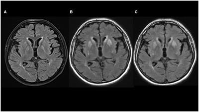 Case report: Rapid-onset parkinsonism after a hornet sting